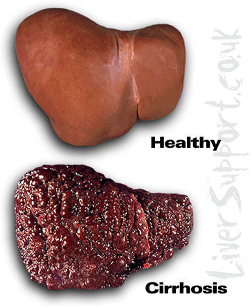 liver_cirrhosis.jpg